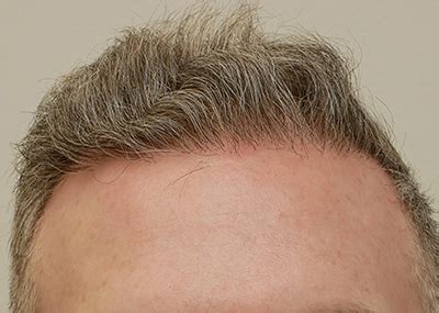 Hair Transplant Expert in Kirkwood .